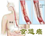 陕西 食道癌的中医治疗方法(西安古城肿瘤防治分院)